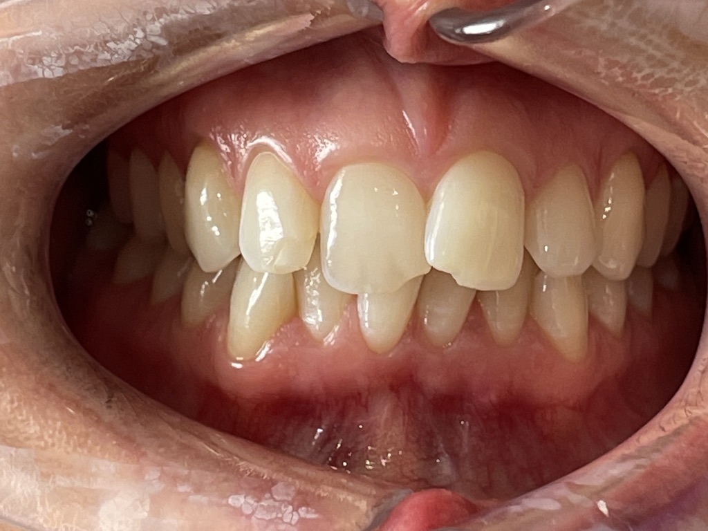Teeth Straightening Leek