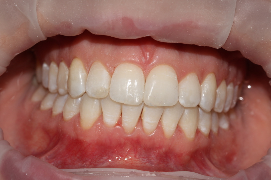 Teeth Straightening Leek